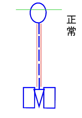 イップス治療　イップス克服　イップス改善　イップス病院